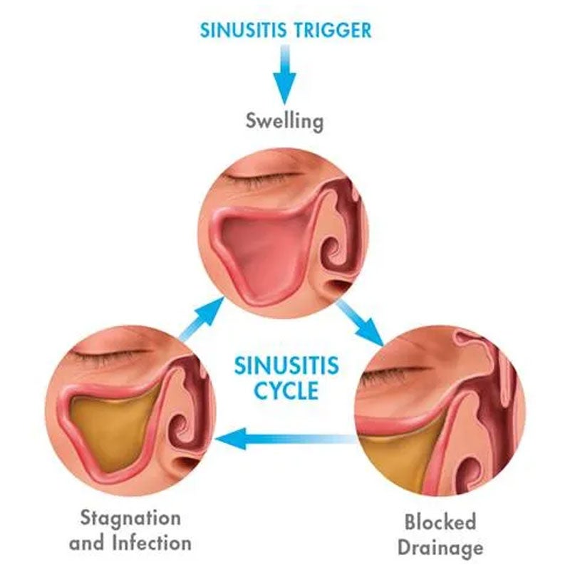 Comprehensive Sinus Treatment In Surprise AZ Comprehensive Sinus Treatment In Surprise AZ